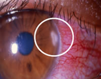 コンタクトレンズによる目の病気 宮前区 宮崎台の眼科 ひまわり眼科 緑内障 白内障 小児眼科
